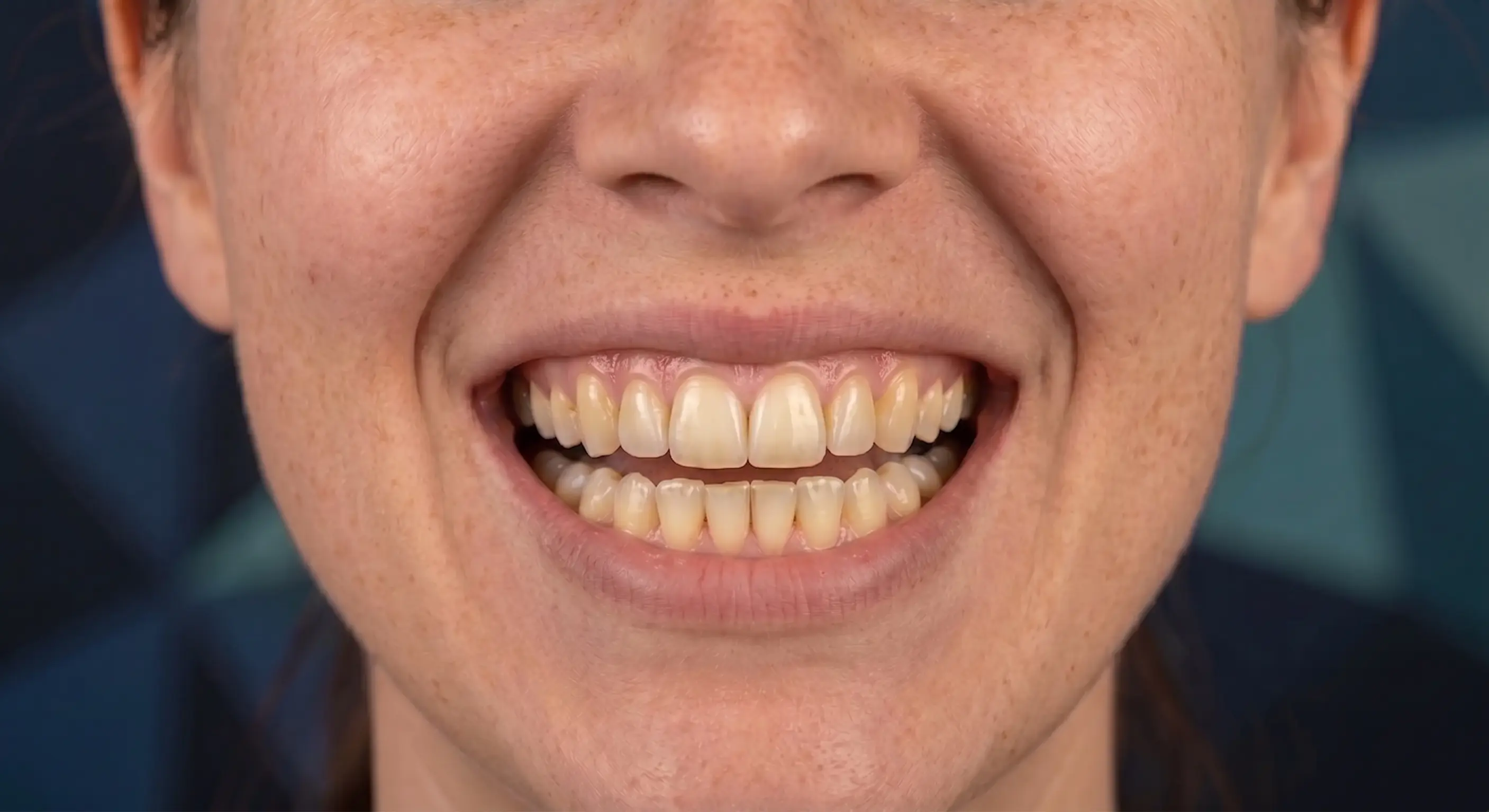 Caso de estética dental — situación antes del tratamiento